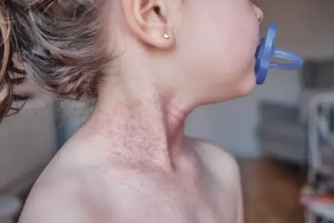 Skóra dziecka z widocznym zaczerwienieniem i zmianami skórnymi na szyi, sugerującymi **egzemę u dzieci**.