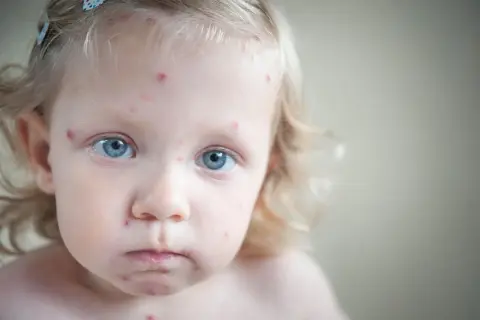 Mała dziewczynka z niebieskimi oczami ma ospę. Czerwone kropki pokrywają jej twarz, wskazując na ospę u niemowlaka.