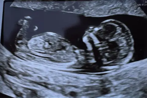 USG płodu, w którym tygodniu widac plec. Dziecko rozwija się, widać jego profil i kręgosłup.