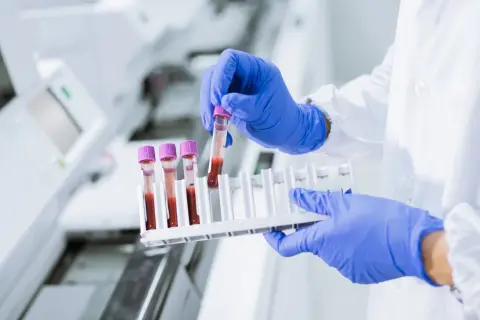 Laborant w niebieskich rękawiczkach pobiera próbkę krwi do analizy. Wyniki badań mogą wykazać bazofile podwyższone u dziecka.
