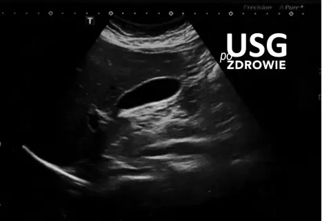 Obraz USG jamy brzusznej z widocznym pęcherzykiem żółtkowym. Badanie potwierdza zdrowie.