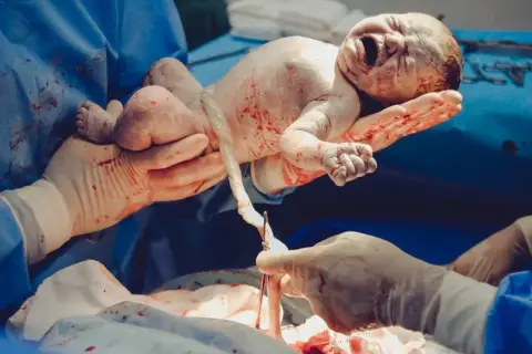 Noworodek po cesarce, trzymany przez dłonie w rękawiczkach, z pępowiną.