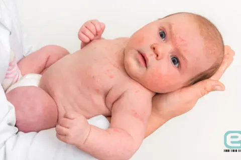Niemowlę z widoczną wysypką alergiczną na twarzy i ciele. Czerwone plamki pokrywają skórę, wskazując na reakcję alergiczną u dziecka.