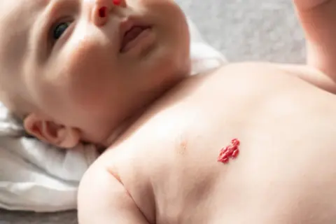 Czerwony naczyniak u noworodka na klatce piersiowej, przypominający małego ludzika.