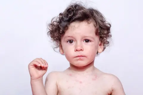 Szkarlatyna kiedy do przedszkola? Sprawdź, kiedy dziecko może wrócić