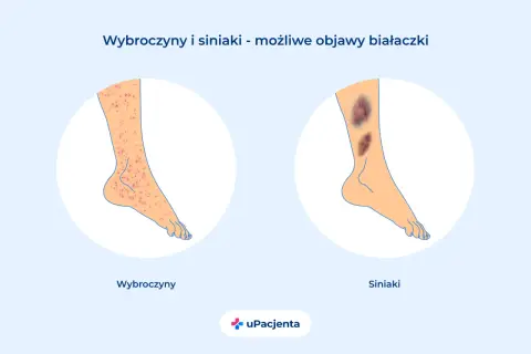 Wybroczyny i siniaki na nogach mogą być objawami białaczki u dzieci. Ilustracja pokazuje nogę z licznymi czerwonymi wybroczynami oraz nogę z ciemnymi siniakami.