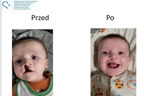 Uśmiechnięte dziecko przed i po korekcji rozszczepu podniebienia. Widoczna poprawa wyglądu twarzy.