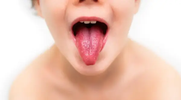 Dziecko z malinowym językiem, objawem szkarlatyny. Szybkie leczenie jest kluczowe.