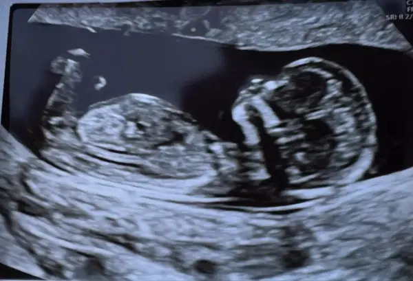USG płodu, w którym tygodniu widac plec. Dziecko rozwija się, widać jego profil i kręgosłup.