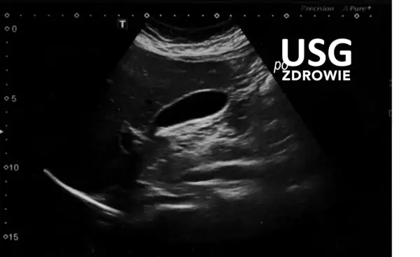 Obraz USG jamy brzusznej z widocznym pęcherzykiem żółtkowym. Badanie potwierdza zdrowie.